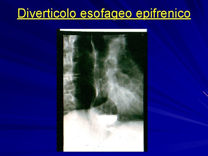 Diverticolo esofageo epifrenico 