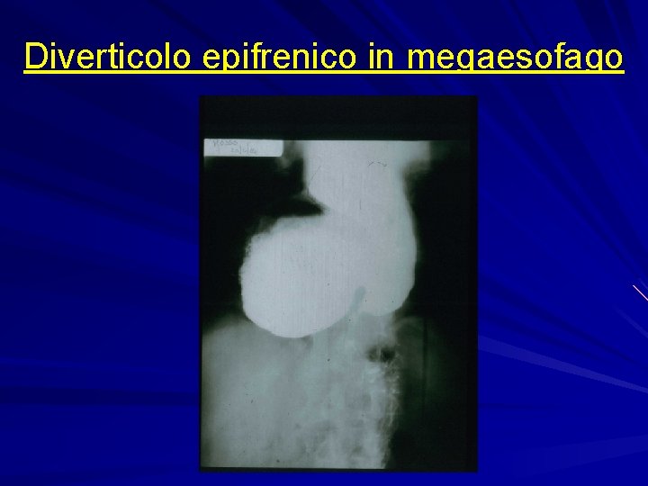 Diverticolo epifrenico in megaesofago 