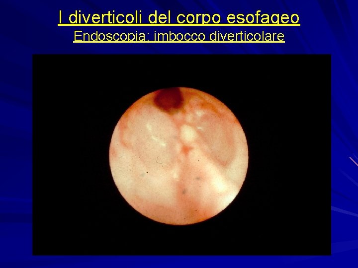 I diverticoli del corpo esofageo Endoscopia: imbocco diverticolare 