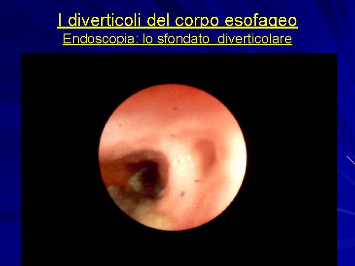 I diverticoli del corpo esofageo Endoscopia: lo sfondato diverticolare 