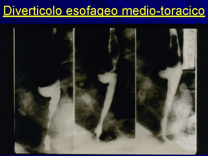 Diverticolo esofageo medio-toracico 