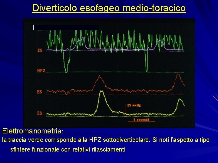 Diverticolo esofageo medio-toracico Elettromanometria: la traccia verde corrisponde alla HPZ sottodiverticolare. Si noti l’aspetto Diverticolo esofageo medio-toracico Elettromanometria: la traccia verde corrisponde alla HPZ sottodiverticolare. Si noti l’aspetto