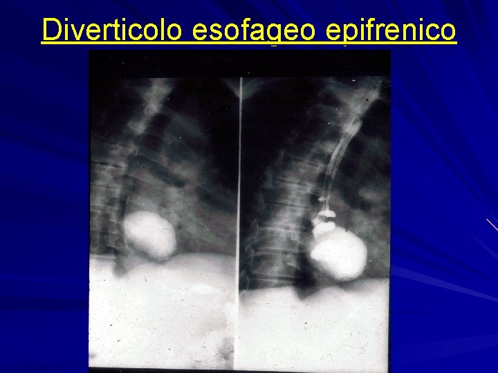 Diverticolo esofageo epifrenico 