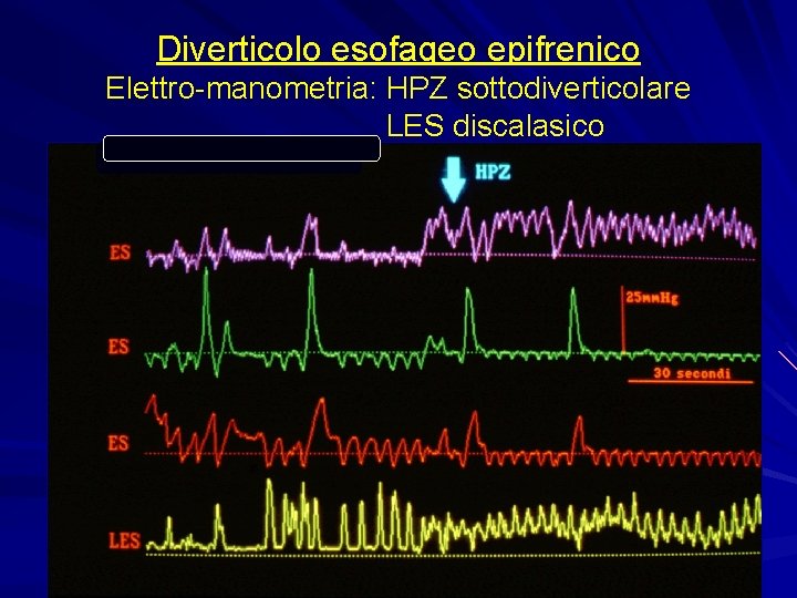 Diverticolo esofageo epifrenico Elettro-manometria: HPZ sottodiverticolare LES discalasico 
