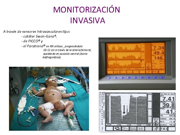 MONITORIZACIÓN INVASIVA A través de sensores intravasculares tipo: - catéter Swan-Ganz®, - de PICCO®