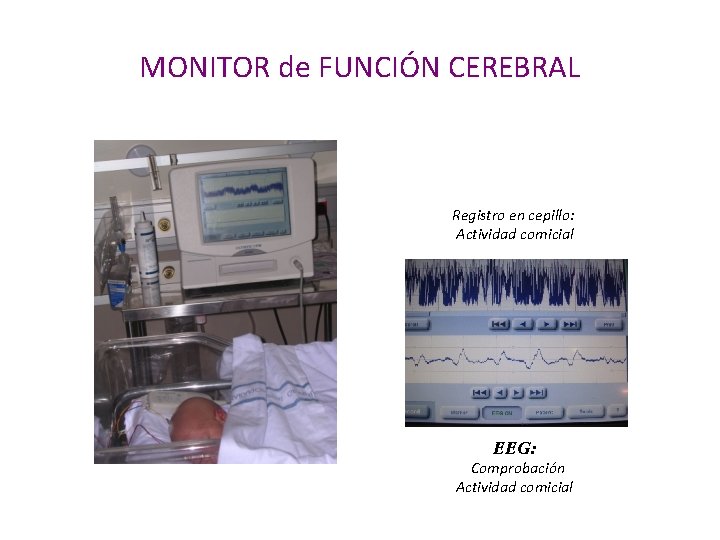 MONITOR de FUNCIÓN CEREBRAL Registro en cepillo: Actividad comicial EEG: Comprobación Actividad comicial 