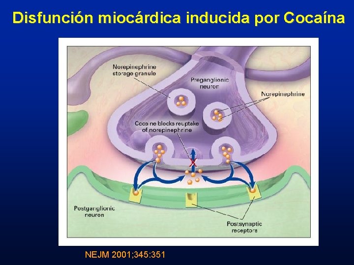 Disfunción miocárdica inducida por Cocaína NEJM 2001; 345: 351 