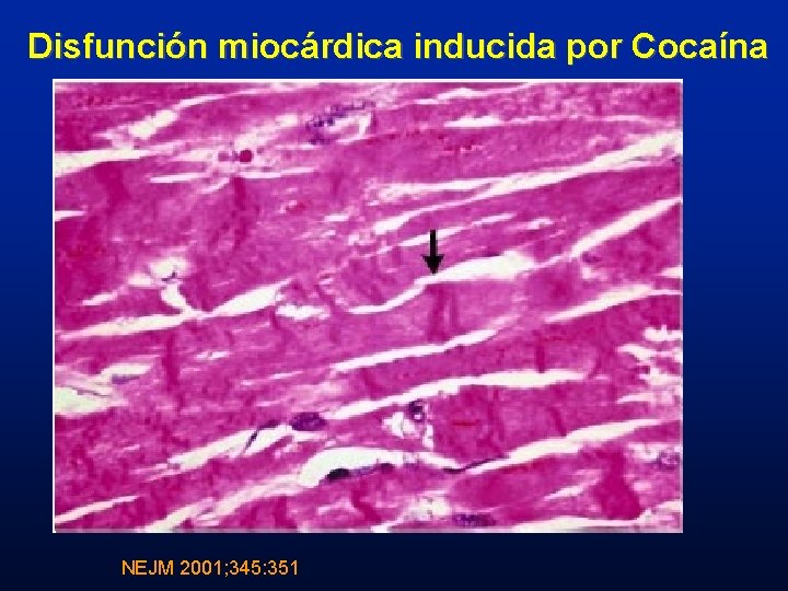 Disfunción miocárdica inducida por Cocaína NEJM 2001; 345: 351 