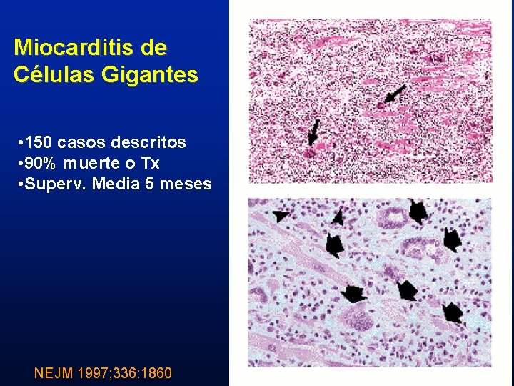 Miocarditis de Células Gigantes • 150 casos descritos • 90% muerte o Tx •