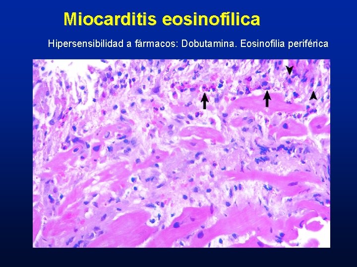 Miocarditis eosinofílica Hipersensibilidad a fármacos: Dobutamina. Eosinofilia periférica 