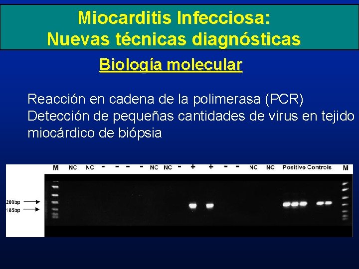 Miocarditis Infecciosa: Nuevas técnicas diagnósticas Biología molecular Reacción en cadena de la polimerasa (PCR)