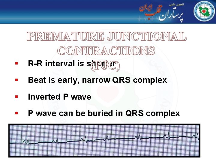 § PREMATURE JUNCTIONAL CONTRACTIONS R-R interval is shorter (PJC) § Beat is early, narrow
