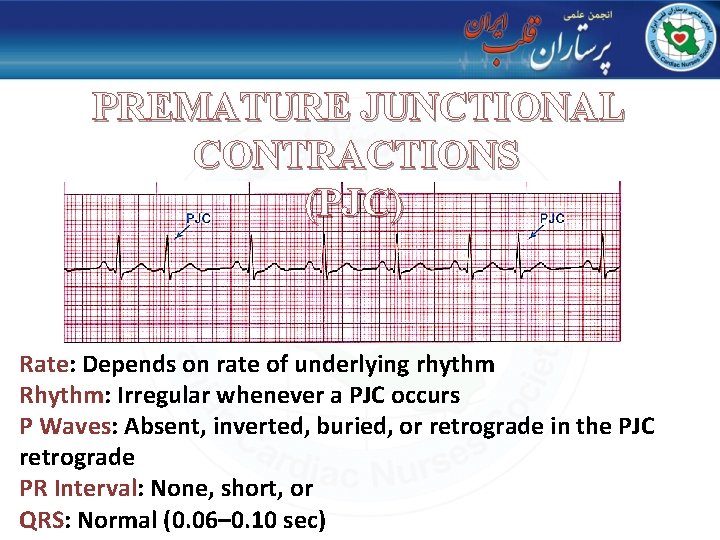 PREMATURE JUNCTIONAL CONTRACTIONS (PJC) Rate: Depends on rate of underlying rhythm Rhythm: Irregular whenever