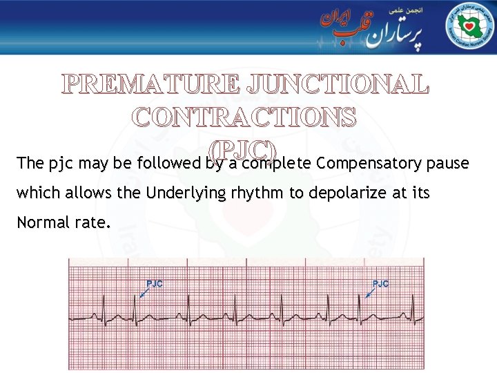 PREMATURE JUNCTIONAL CONTRACTIONS (PJC) The pjc may be followed by a complete Compensatory pause