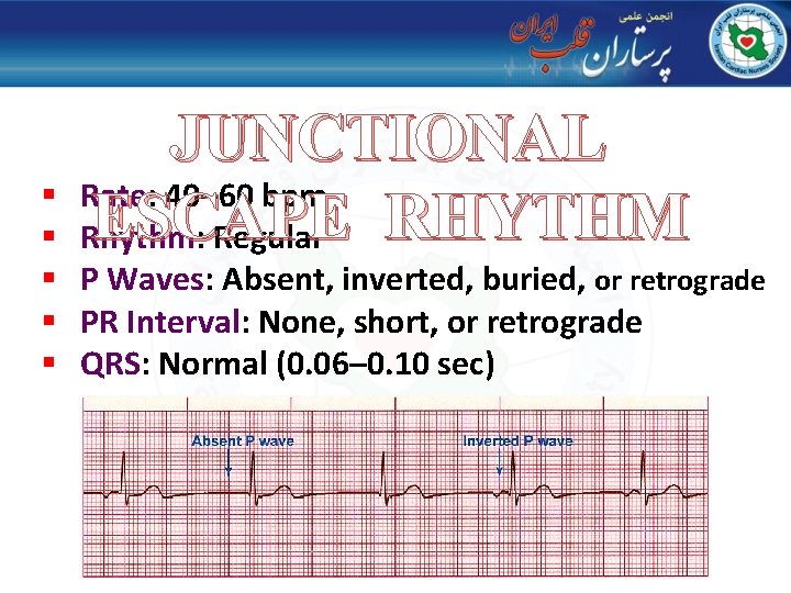 JUNCTIONAL Rate: 40– 60 bpm ESCAPE RHYTHM Rhythm: Regular § § § P Waves: