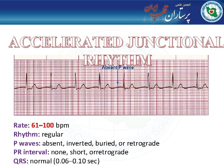 ACCELERATED JUNCTIONAL RHYTHM Rate: 61– 100 bpm Rhythm: regular P waves: absent, inverted, buried,