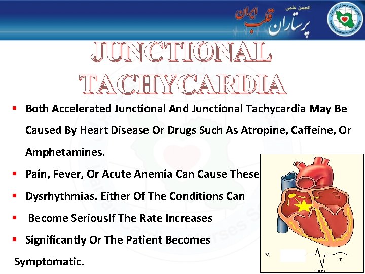 JUNCTIONAL TACHYCARDIA § Both Accelerated Junctional And Junctional Tachycardia May Be Caused By Heart