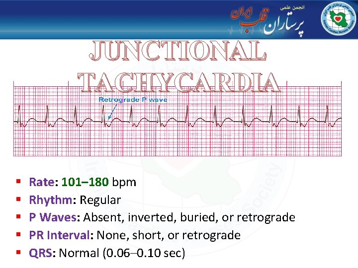 JUNCTIONAL TACHYCARDIA § § § Rate: 101– 180 bpm Rhythm: Regular P Waves: Absent,