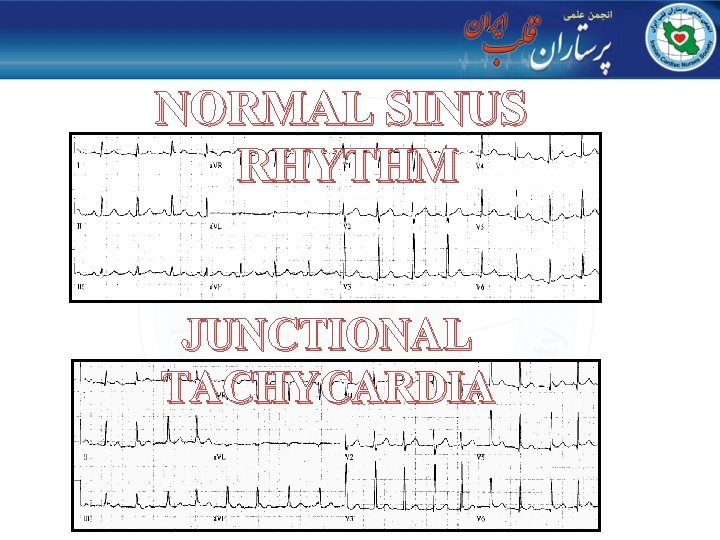 NORMAL SINUS RHYTHM JUNCTIONAL TACHYCARDIA 