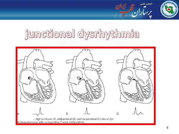 junctional dysrhythmia 6 