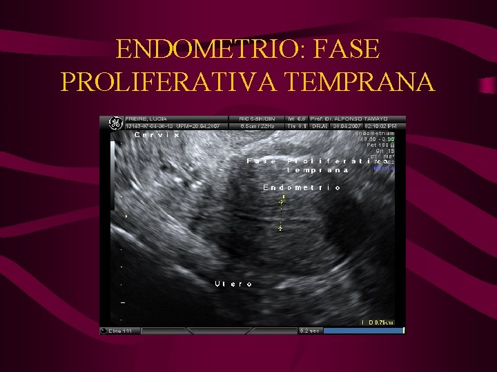 ENDOMETRIO: FASE PROLIFERATIVA TEMPRANA 