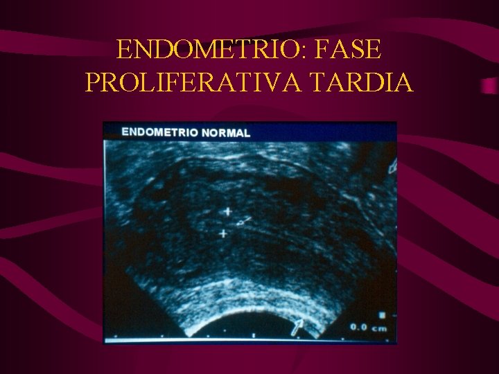 ENDOMETRIO: FASE PROLIFERATIVA TARDIA 