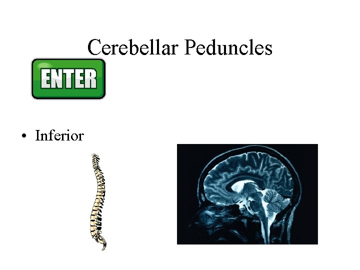 Cerebellar Peduncles • Inferior Cerebellar Peduncles • Inferior