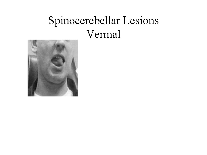 Spinocerebellar Lesions Vermal Spinocerebellar Lesions Vermal