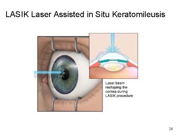 LASIK Laser Assisted in Situ Keratomileusis 26 