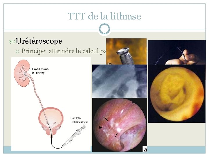 TTT de la lithiase Urétéroscope Principe: atteindre le calcul par voie rétrograde Morbidité minime