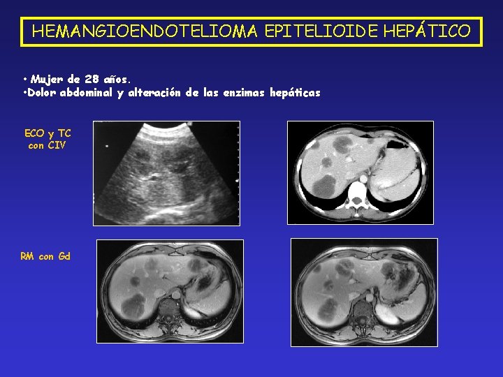 HEMANGIOENDOTELIOMA EPITELIOIDE HEPÁTICO • Mujer de 28 años. • Dolor abdominal y alteración de