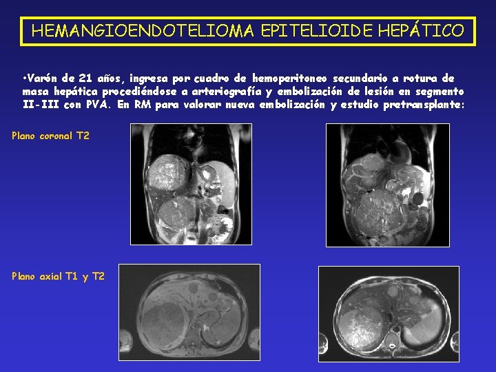 HEMANGIOENDOTELIOMA EPITELIOIDE HEPÁTICO • Varón de 21 años, ingresa por cuadro de hemoperitoneo secundario