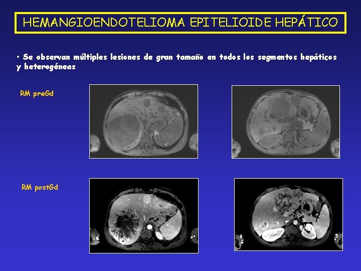 HEMANGIOENDOTELIOMA EPITELIOIDE HEPÁTICO • Se observan múltiples lesiones de gran tamaño en todos los