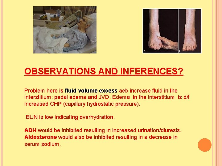 OBSERVATIONS AND INFERENCES? Problem here is fluid volume excess aeb increase fluid in the OBSERVATIONS AND INFERENCES? Problem here is fluid volume excess aeb increase fluid in the