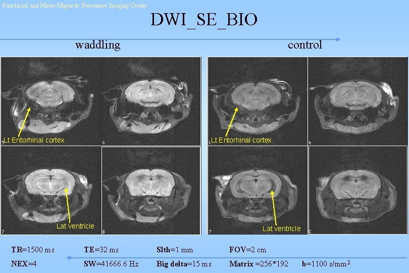 Functional and Micro-Magnetic Resonance Imaging Center DWI_SE_BIO waddling control Lt Entorhinal cortex Lat ventricle