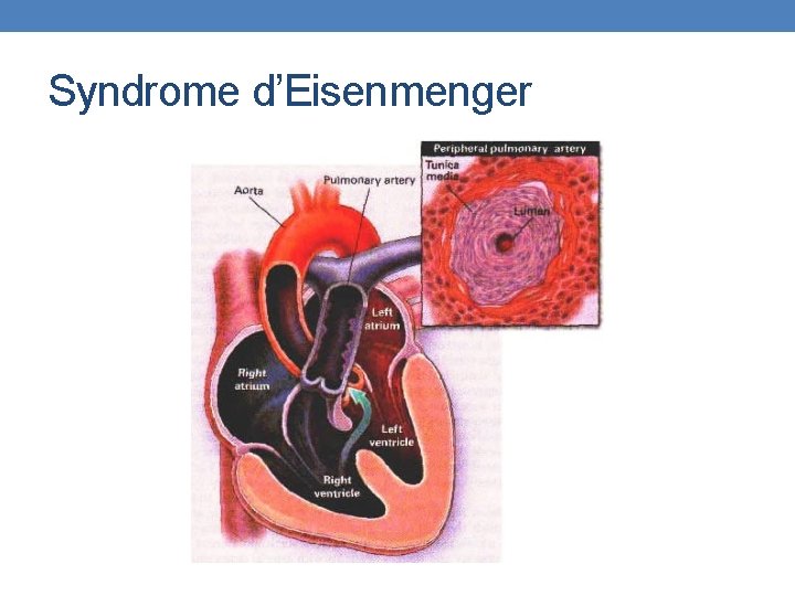 Syndrome d’Eisenmenger 