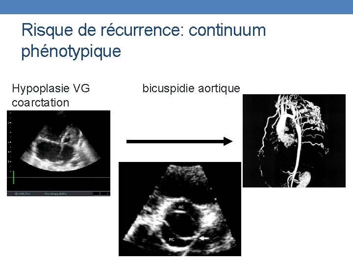 Risque de récurrence: continuum phénotypique Hypoplasie VG bicuspidie aortique coarctation 