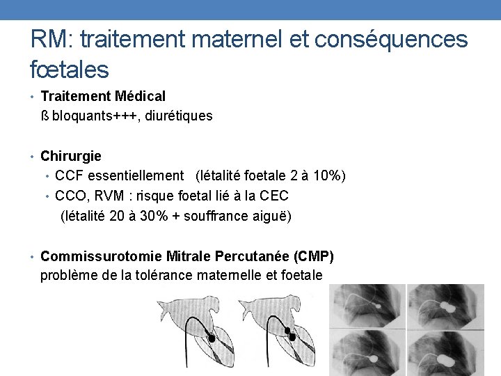 RM: traitement maternel et conséquences fœtales • Traitement Médical ß bloquants+++, diurétiques • Chirurgie