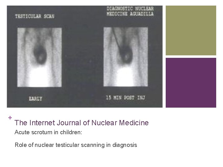 + The Internet Journal of Nuclear Medicine Acute scrotum in children: Role of nuclear