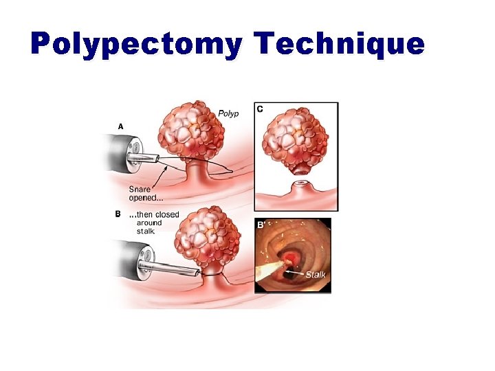 Polypectomy Definition Colorectal cancer Screening and Prevention Dr malek Alhamidi