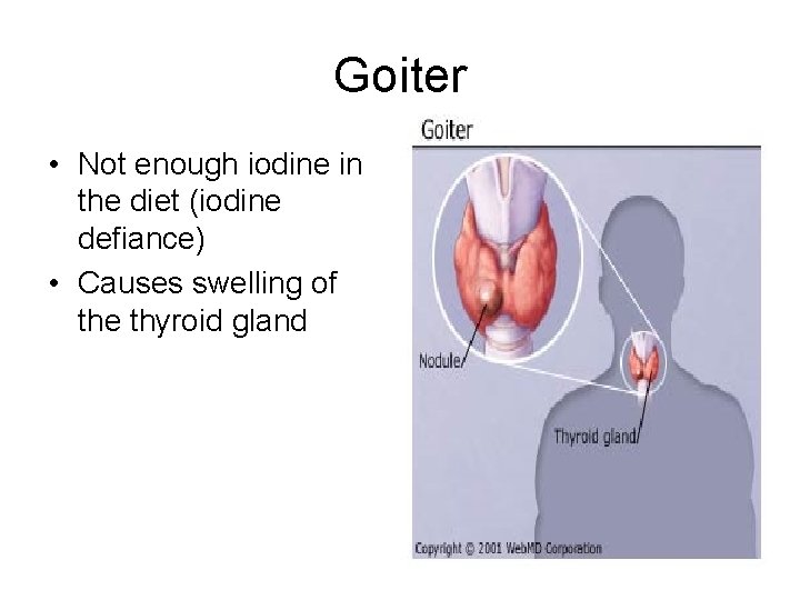 Goiter • Not enough iodine in the diet (iodine defiance) • Causes swelling of