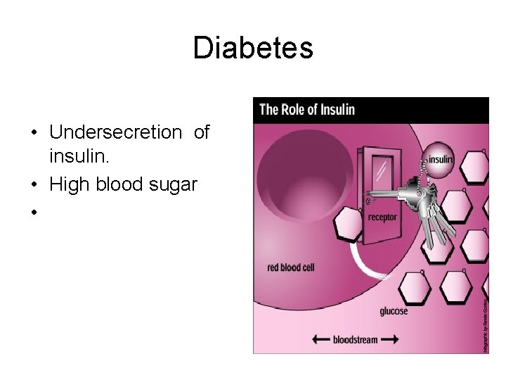 Diabetes • Undersecretion of insulin. • High blood sugar • 