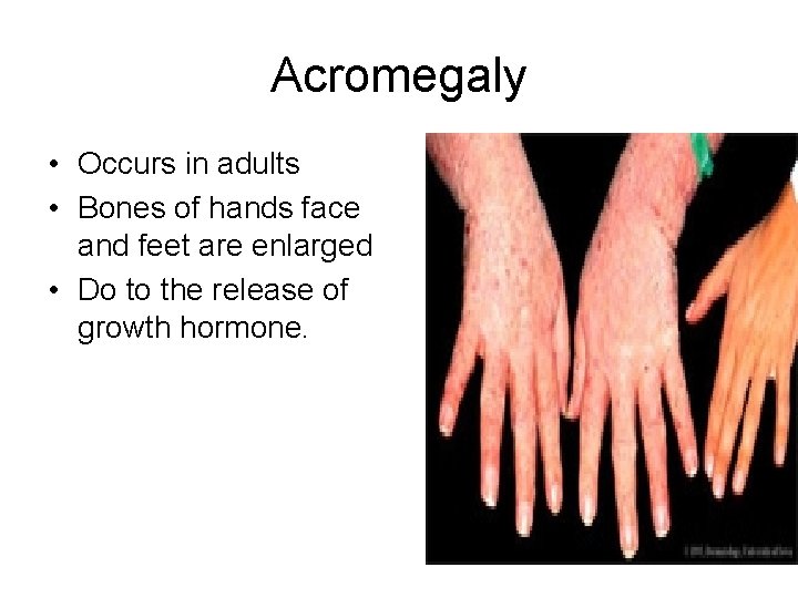 Acromegaly • Occurs in adults • Bones of hands face and feet are enlarged