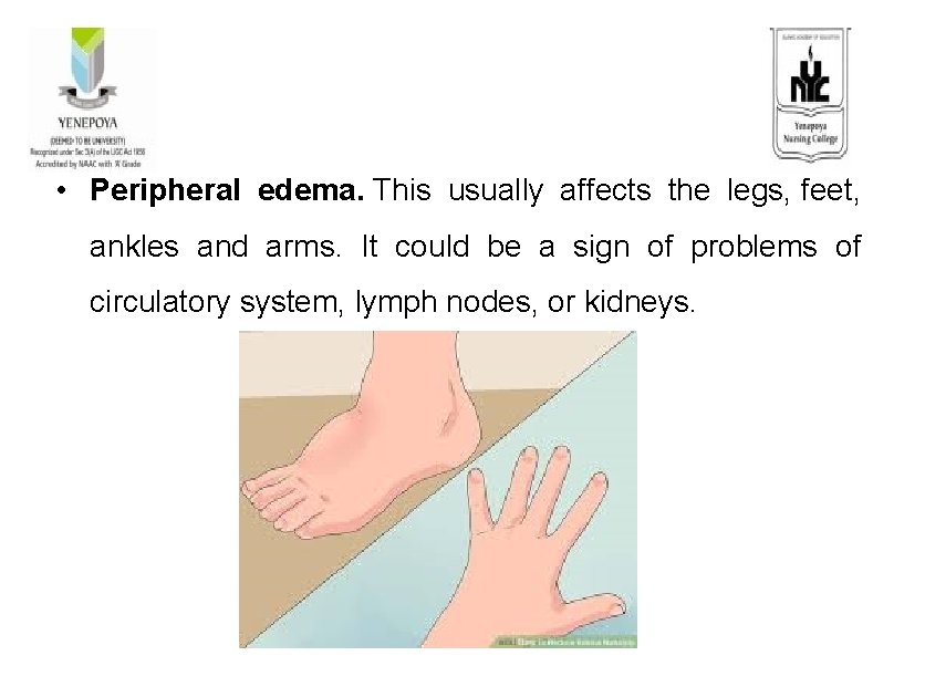  • Peripheral edema. This usually affects the legs, feet, ankles and arms. It