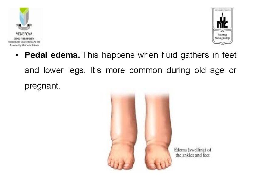  • Pedal edema. This happens when fluid gathers in feet and lower legs.