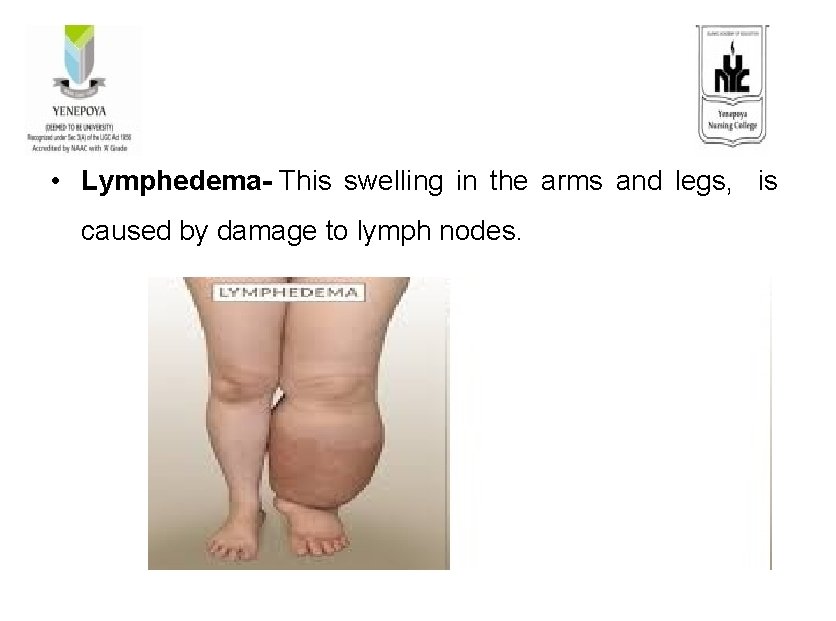  • Lymphedema- This swelling in the arms and legs, is caused by damage