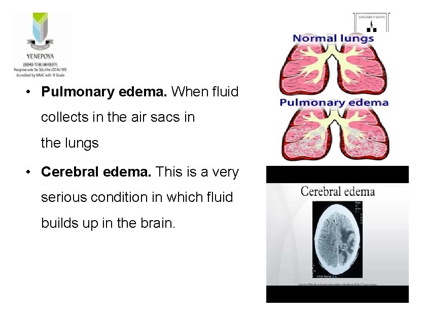  • Pulmonary edema. When fluid collects in the air sacs in the lungs