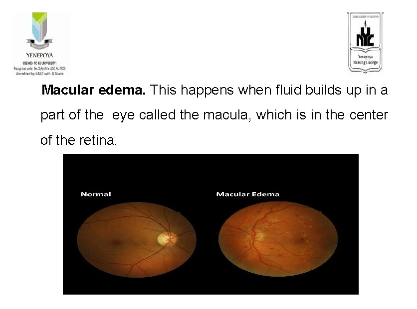  Macular edema. This happens when fluid builds up in a part of the