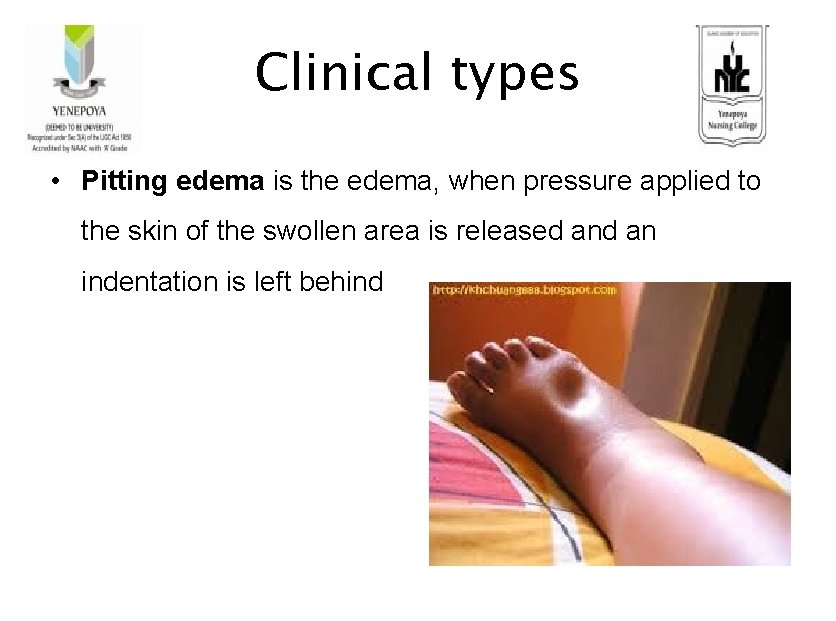 Clinical types • Pitting edema is the edema, when pressure applied to the skin