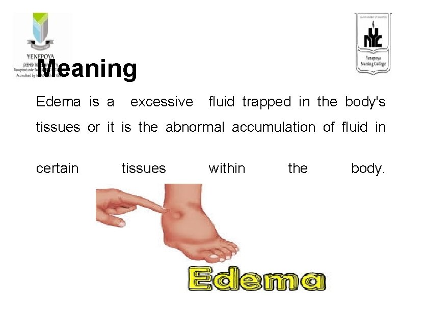 Meaning Edema is a excessive fluid trapped in the body's tissues or it is